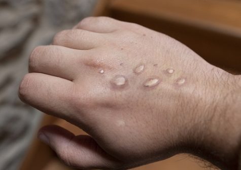 Monkey pox vesicles in a hand